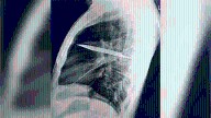 Man’s chest begins to leak pus. Doctors find a knife blade there