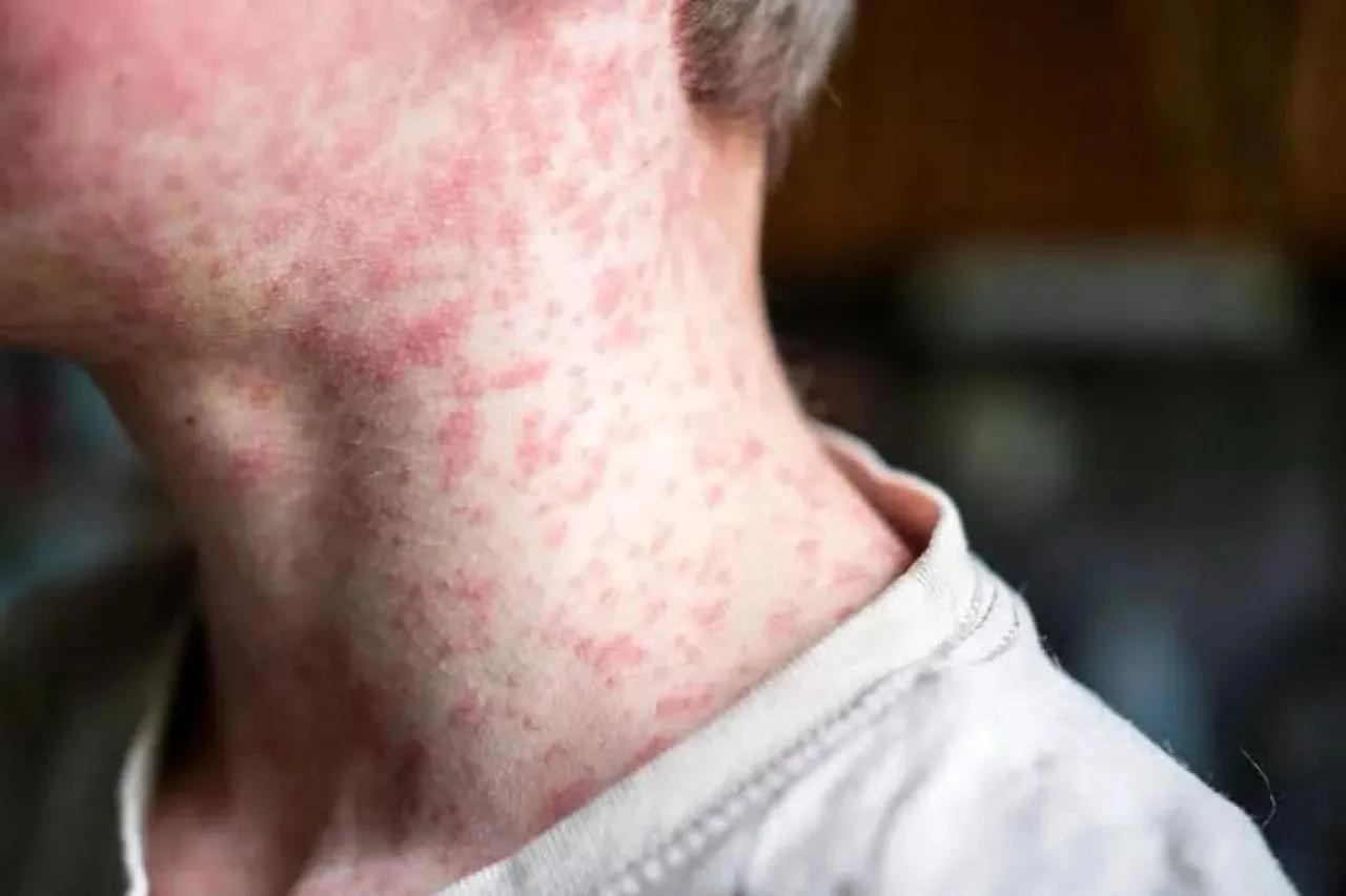 Declara Texas el fin del brote de sarampión en el estado