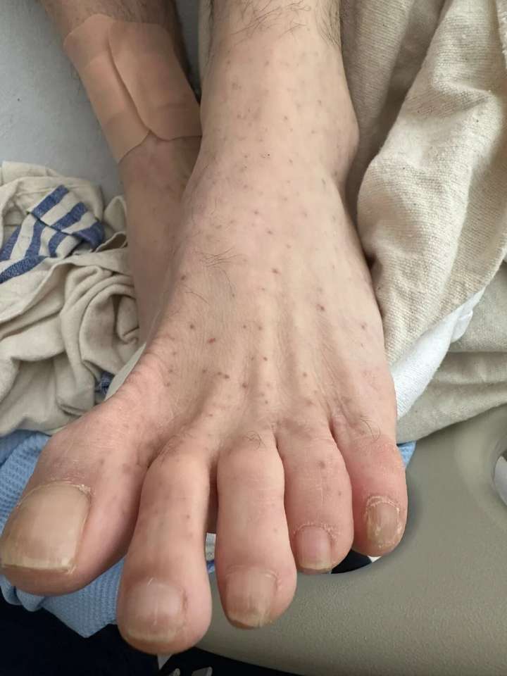 Tick-borne Rocky Mountain spotted fever spreading in Canada