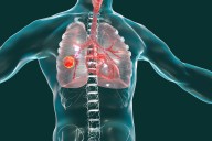 FDA Grants Accelerated Approval to First Oral Targeted Therapy for HER2