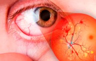 Retinopatía Diabética, de las principales causas de ceguera en México