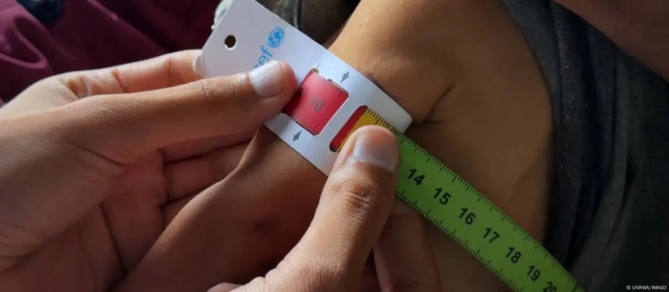 Van más de cien niños muertos por desnutrición en Gaza