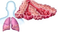 RA May Be a Causal Driver of Idiopathic Pulmonary Fibrosis