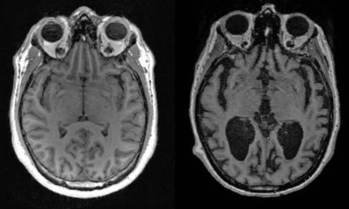 Científicos de Harvard descubren que la deficiencia de litio conduce a padecer Alzheimer