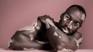Vitiligo Tied to Alopecia, RA, Other Autoimmune Diseases