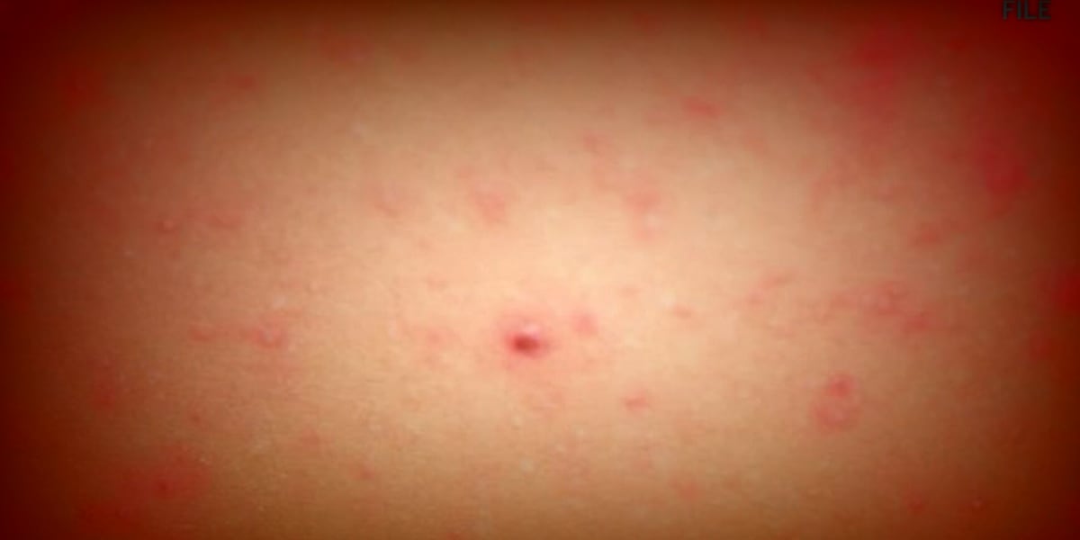 Measles detected in Clark County wastewater, no local cases confirmed