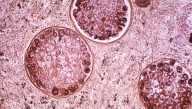 Valley Fever cases surge across California in 2025