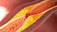 Una técnica española de imagen usada en cáncer podría mejorar el abordaje de la aterosclerosis