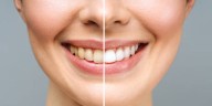 Este es el mejor remedio casero para blanquear tus dientes y lucir una mejor sonrisa