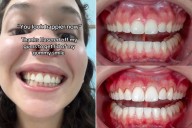 Woman Goes Viral for Video About Lasering Her 'Gummy Smile' (Exclusive)