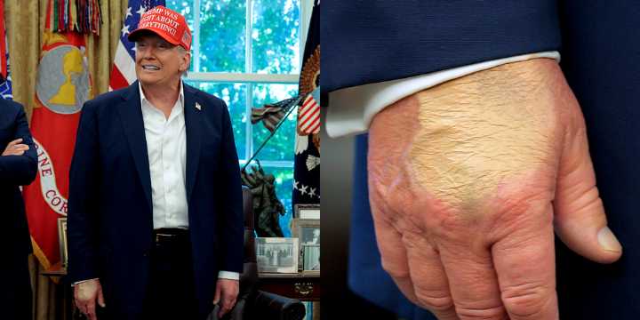 Donald Trump Pictured with Makeup Covering His Right Hand After Doctor’s Recent Comments About Bruising 