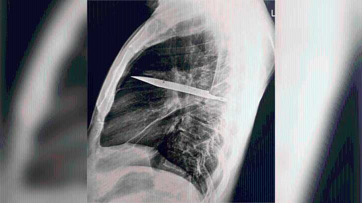 Man’s chest begins to leak pus. Doctors find a knife blade there