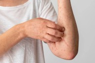 Ocho alimentos más deliciosos que causan la mayoría de las alergias