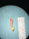 Rare ‘tooth-in-eye’ surgery restores man’s vision after two decades