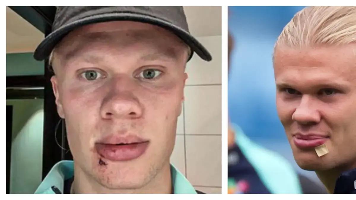El accidente de Haaland que lo dejó con tres puntos en la cara previo a partido de eliminatorias al Mundial