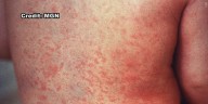 South Carolina officials report third case of measles since July