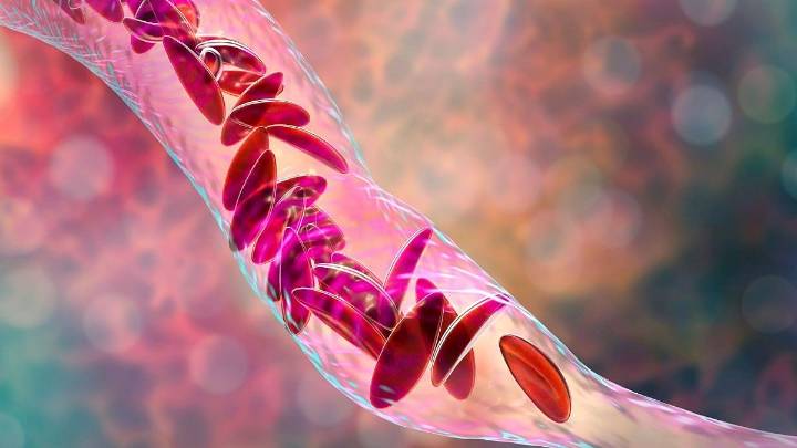 Exa-Cel Gene Therapy Improves Quality of Life in Severe Sickle Cell Disease