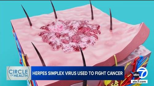 USC researchers turn common herpes virus into cancer fighting tool in RP