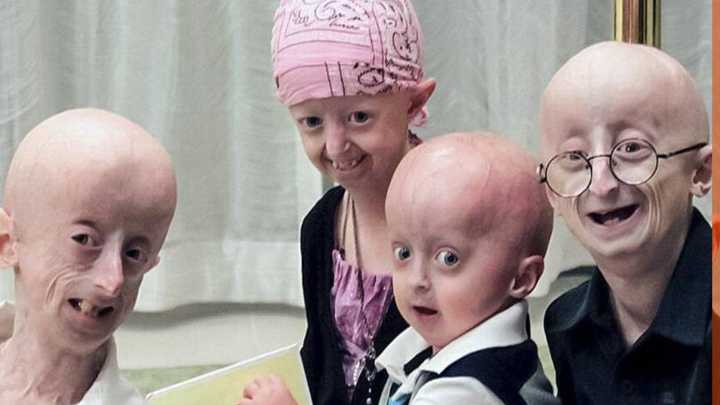 Progeria: cuando la niñez se acelera hacia la vejez