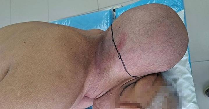 Man who lived with head-sized neck tumour for 16 years FINALLY goes to hospital