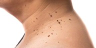 ¿Cuál es la diferencia entre las verrugas en el cuello y la acantosis nigricans?