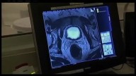 CBCC offering free prostate screening in September -