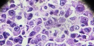 Osteosarcoma: tasas de supervivencia y factores que influyen en el pronóstico