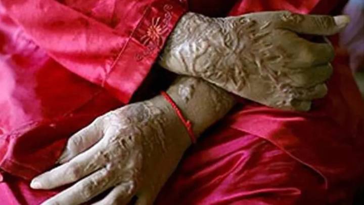 ‘Want him to suffer the same pain’: Sambhal teacher attacked with acid; accused held after shootout