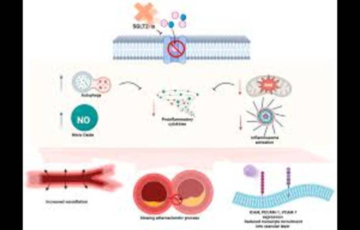 Sitagliptin Promotes DFU Healing Independent of Glucose Control: Study