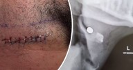Golfer tells of delicate surgery to remove pellet after being shot in neck on Middlesbrough course