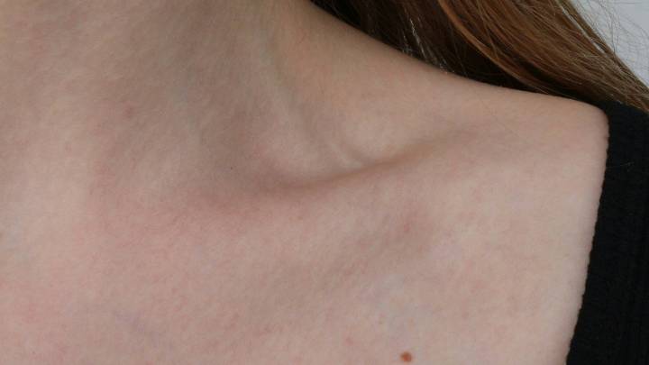 Cinco remedios caseros para eliminar verrugas del cuello de forma eficaz con ingredientes de cocina, sin riesgos