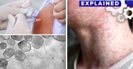 Measles Cases Rising 2025: Why it's happening, where the cases are coming from and everything to know