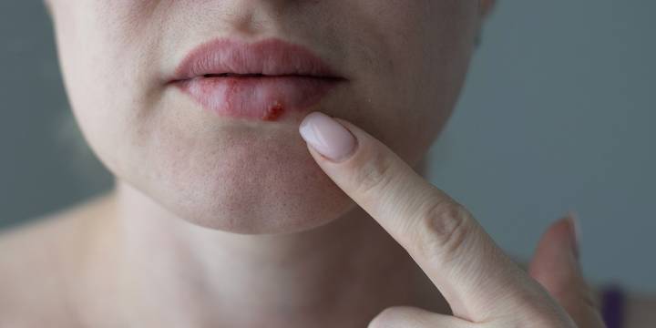 Herpes, una infección invisible: cómo y por qué puede aparecer tras años oculta