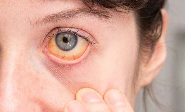 Síndrome de Gilbert: qué es, síntomas y tratamiento