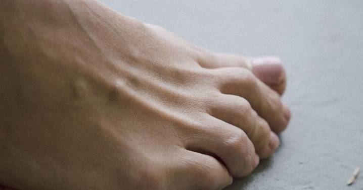 Scientists suggest ancient gene could offer cure for gout