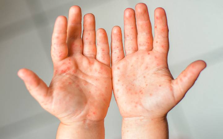México suma más de 4 mil 300 casos de sarampión; 17 muertes ligadas a la enfermedad