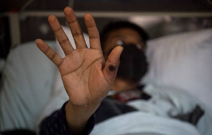 Levanta OMS alerta de emergencia sanitaria por viruela símica
