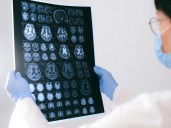 Sorpresivo hallazgo contra el Alzheimer por el efecto de dos vacunas que hoy se usan para otras enfermedades