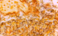 Why Syphilis Cases in Newborns Are Rising