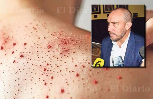 Registra SSE 17 muertes por casos de sarampión