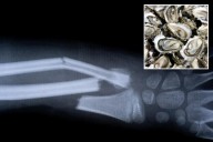 China made Bone 02 glue fixes fractures in just three minutes with one injection