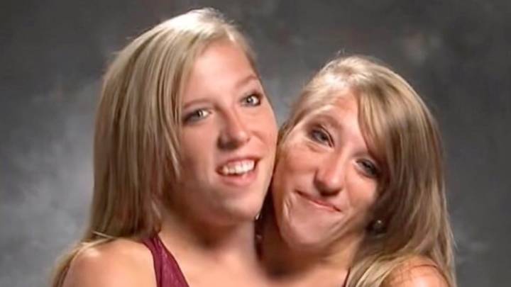 Conjoined twins Abby and Brittany Hensel spark reaction with never