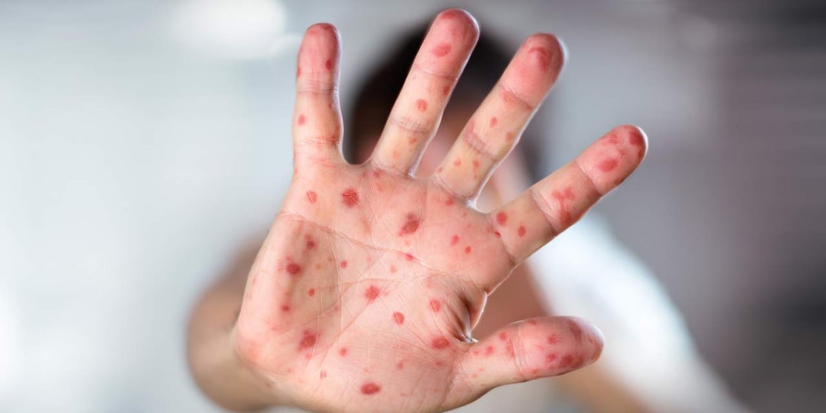 Measles confirmed in an unvaccinated Georgia resident with no international travel history