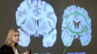 Here's what to know about CTE, the brain disease the NYC shooter blamed for his mental health issues