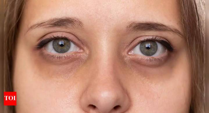 Dark circles under your eyes may reveal signs of kidney failure, liver disease, and more