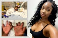 My legs and fingers were amputated and doctors cut rotting flesh from bum after 'Fresher's flu'