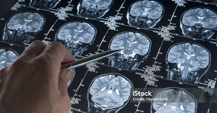 Las personas con un alto nivel educativo podrían ser diagnosticadas con alzhéimer más tarde que el resto