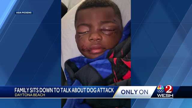 Daytona Beach 4-year-old recovering after dog attack