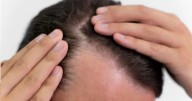 ¿A qué edad empieza la caída del pelo en hombres? Esto dice la ciencia sobre la calvicie