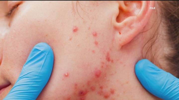 3 new measles cases in Georgia, all linked to Fulton County resident
